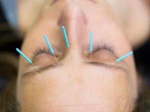 Acupuncture-for-headaches