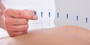 acupuncture (1)